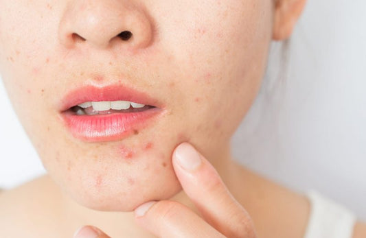 Why Late Lunches Might Be Triggering Your Acne (And How to Heal It Holistically)