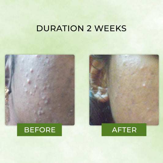 Neem & Moringa Soap | Medicinal Treatment Bar