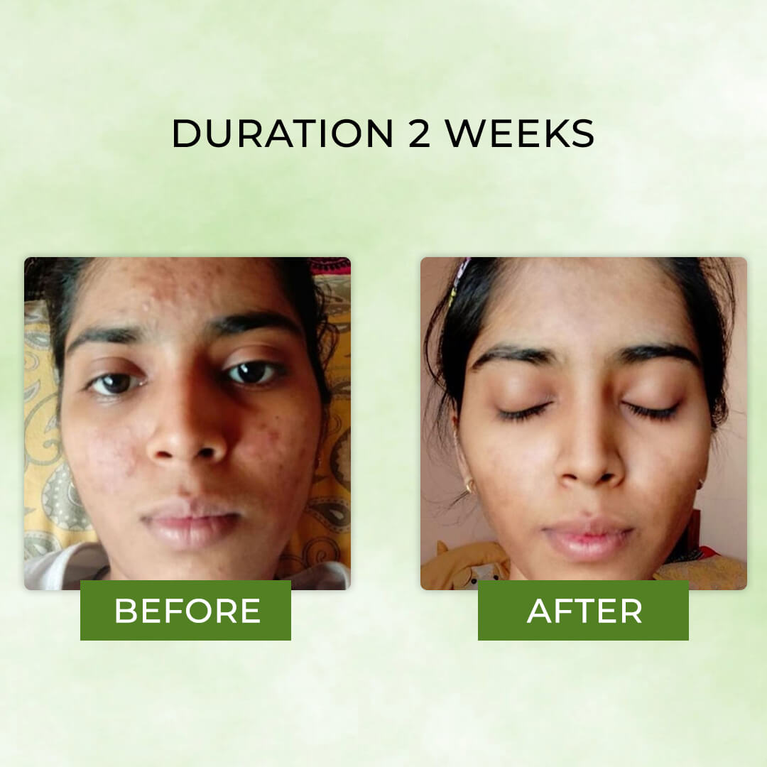 Neem & Moringa Soap | Medicinal Treatment Bar