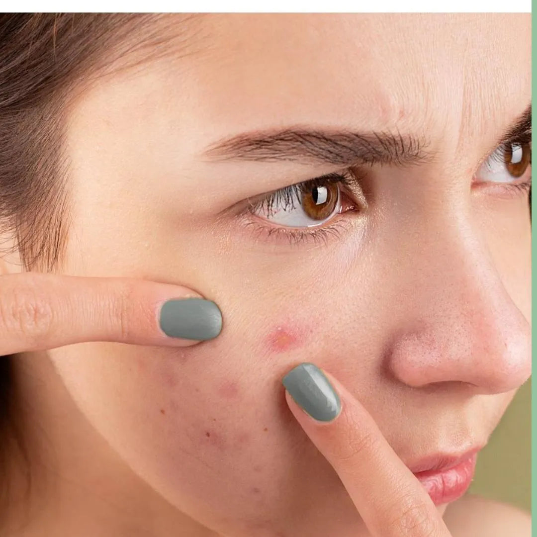 Is your Acne Because of Periods? Find out here.