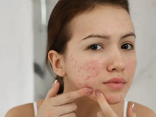 Trending Acne Creams Promise Oil Control — But Are They Truly Healing Your Skin?