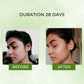acne spots before and afre