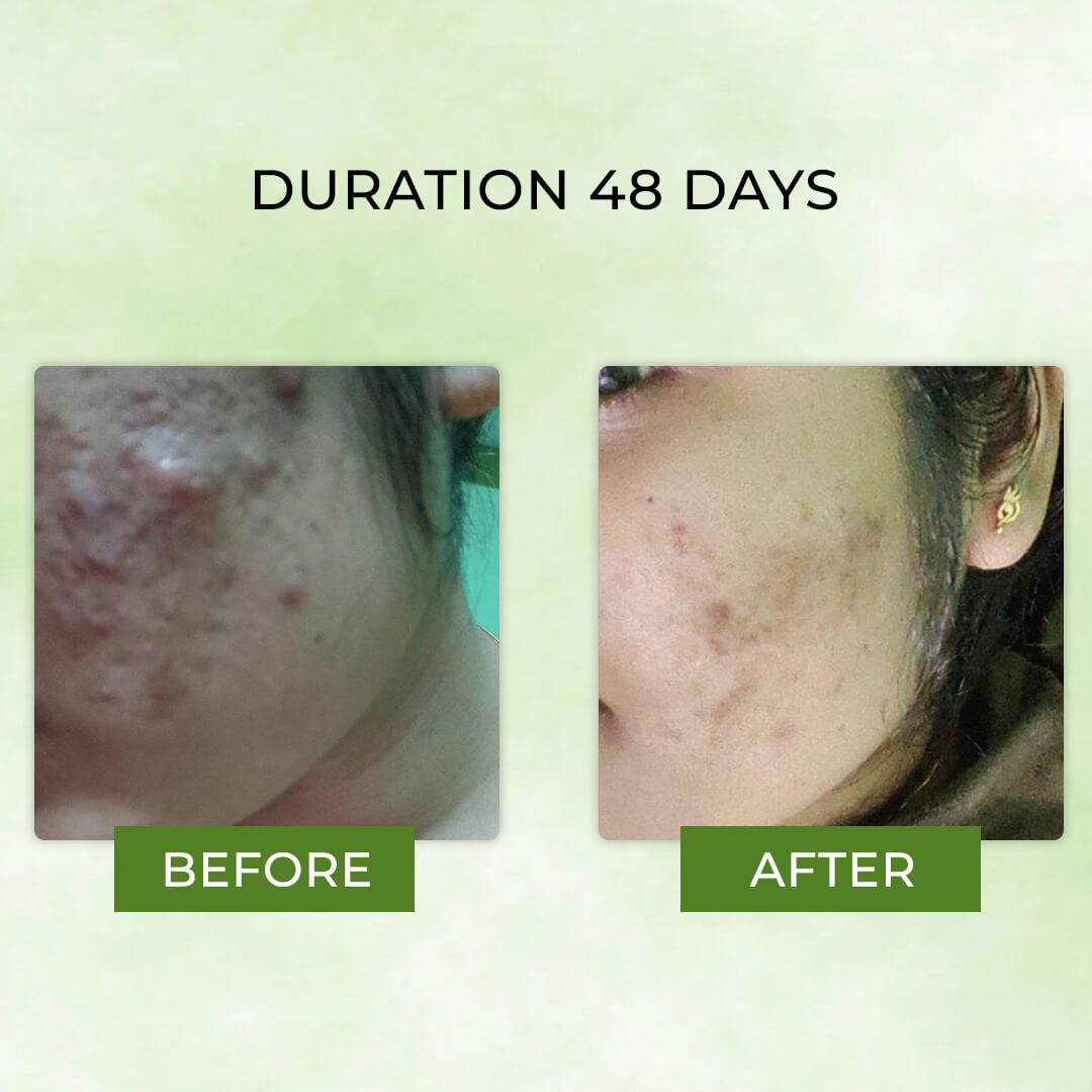 acne transformation indian